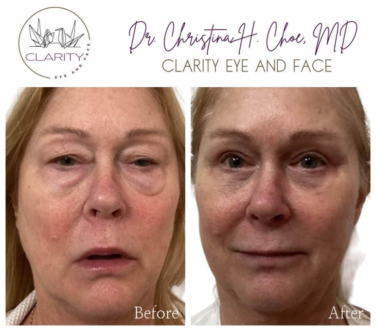Lower Blepharoplasty