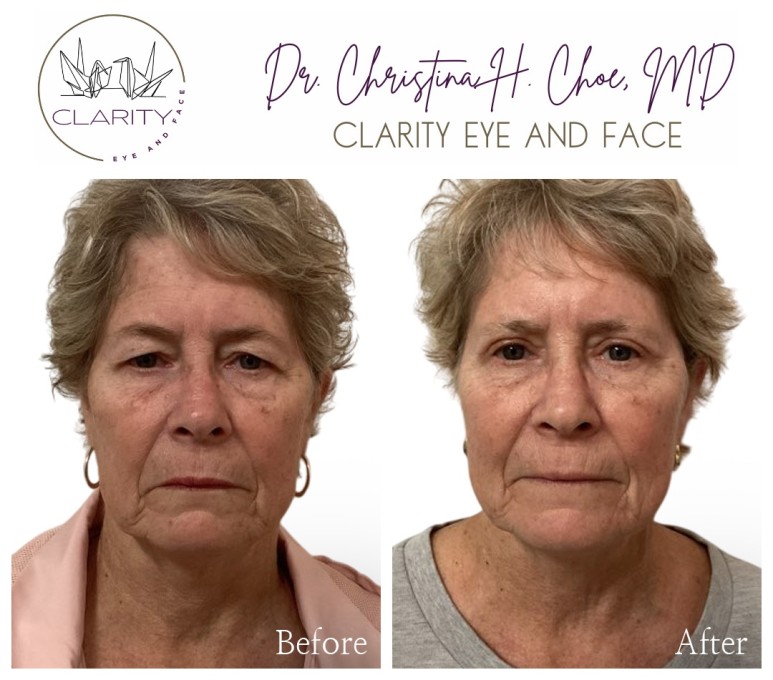 Upper blepharoplasty