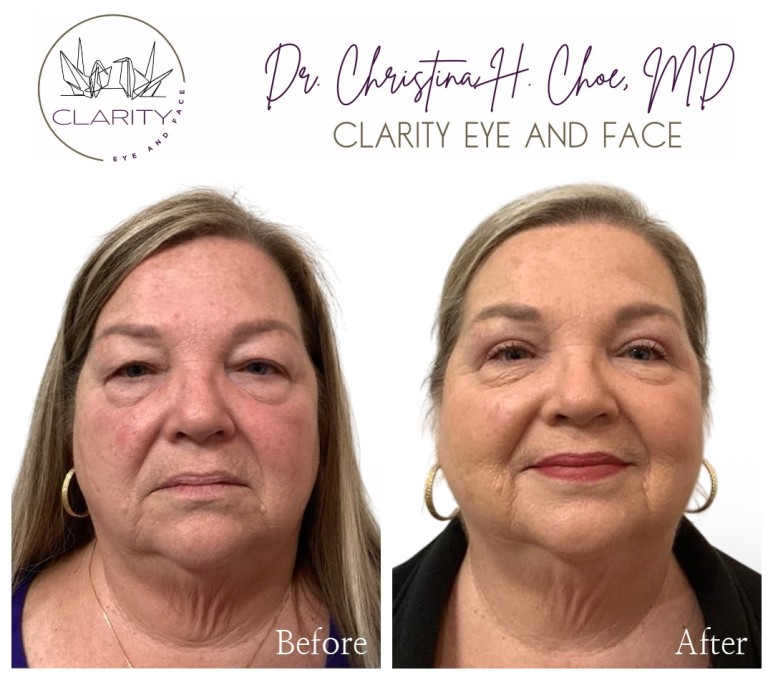 Upper blepharoplasty