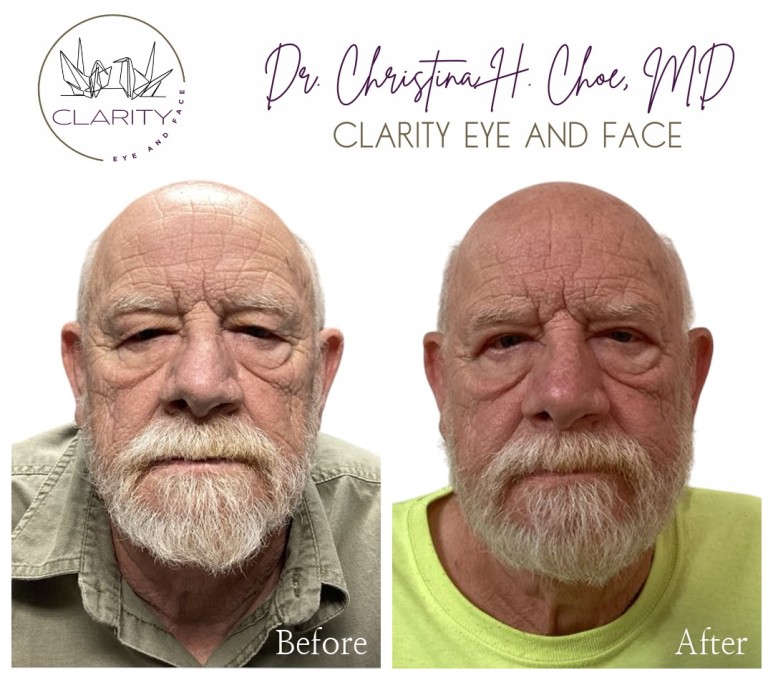Upper blepharoplasty