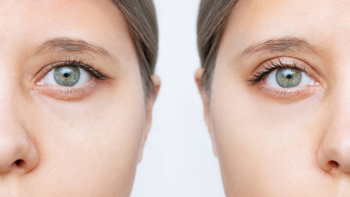 Featured image for How Long Will It Take to See the Final Results of Upper Blepharoplasty​?